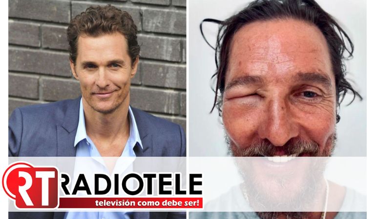 Matthew McConaughey sorprende al mostrar ojo hinchado por picadura de abeja