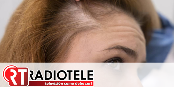 Alopecia femenina: la enfermedad silenciosa que muchas mujeres ocultan bajo pelucas y extensiones