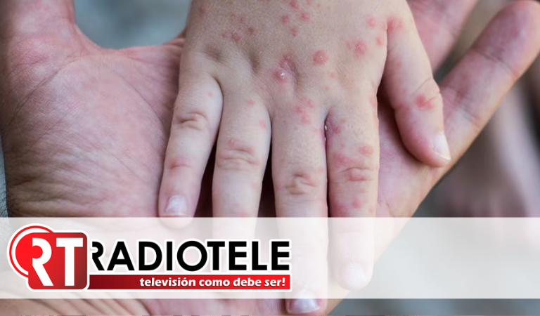 ¿Qué es el virus coxsackie?: síntomas, cómo se contagia y tratamiento