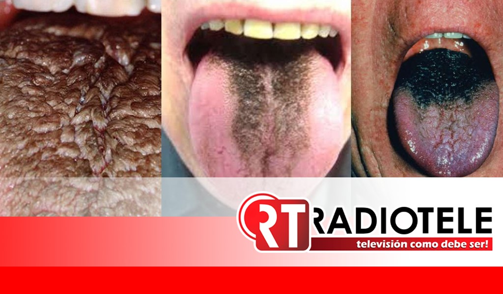 Enfermedad de la “lengua peluda negra”, hombre en India es diagnosticado