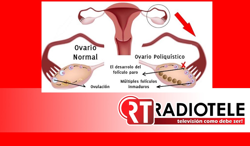 En el marco del Día de la Madre, Síndrome de ovario poliquístico: trastorno hormonal que podría causar infertilidad en jóvenes mexicanas